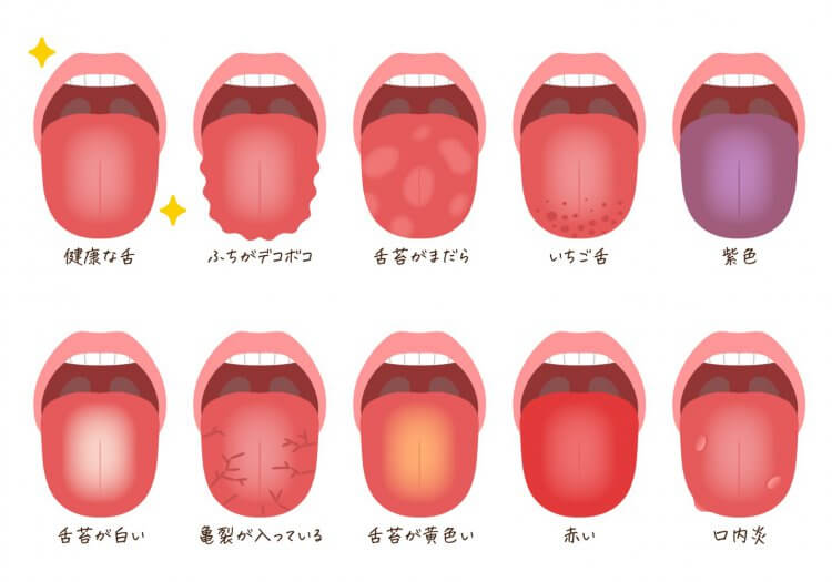 舌 の ふち が でこぼこ ストレス